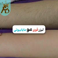 لیزر مو زائد مادام العمر و تضمینی مایا بیوتی|خدمات آرایشگری و زیبایی|یاسوج, |دیوار
