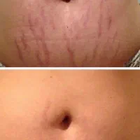 کربوکسی جای زخم و جوش بهبود ظاهر پوست ویزیت رایگان