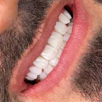 کامپوزیت دندان