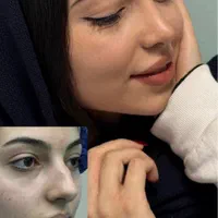 عمل جراحی بینی فقط ۲۴ میلیون/لیفت صورت/کرج و تهران|خدمات آرایشگری و زیبایی|قزوین, |دیوار