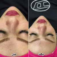 فیشال تخصصی  (پکیج دور چشم هدیه)