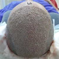 کاشت مو تخصصی دلربا|خدمات آرایشگری و زیبایی|حمیدیه, |دیوار