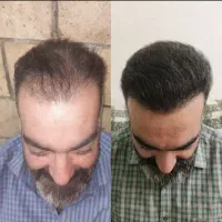 کاشت مو|خدمات آرایشگری و زیبایی|مریوان, |دیوار