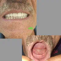 ساخت دندان مصنوعی اقتصادی وبا کیفیت|خدمات آرایشگری و زیبایی|ری, دیلمان|دیوار