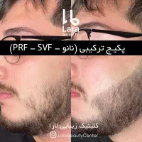 پی آر پیPRP درمان ریزش مو مزوتراپی هیرفیلر کاشت مو|خدمات آرایشگری و زیبایی|تهران, صادقیه|دیوار