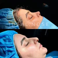 جراحی بینی با شرایط اقساطی