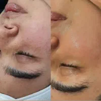 فیشیال تخصصی و درمان انوع مشکل های پوستی