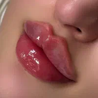 وای فول فیس بوتاکس فیلربا ۸۰٪تخفیف به مدت محدود
