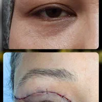 جراحی عمل پلک/بلفاروپلاستی/ پف زیرچشم /چشم گربه