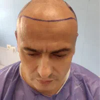 جشنواره کاشت مو و مزوتراپی|خدمات آرایشگری و زیبایی|مشهد, احمدآباد|دیوار