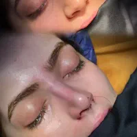 جراحی زیبایی بینی توسط متخصص ENT