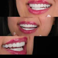 افر کامپوزیت دندان مواد درجه یک