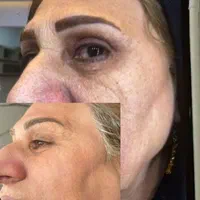 درمان تک جلسه ای تضمینی کک و مک ،لک،اسکار ،جوش|خدمات آرایشگری و زیبایی|قزوین, |دیوار