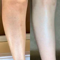 لیزر مو های زایددستگاه کندلا (شاتی ) بهترین۲۰۲۵|خدمات آرایشگری و زیبایی|کرج, احدآباد|دیوار