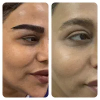 کاشت ابرو ویژه