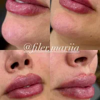 تزریق فیلر صورت مطابق المانهای زیبایی شناسی|خدمات آرایشگری و زیبایی|قرچک, پویینک|دیوار