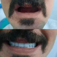 دندان مصنوعی لمینتی مشاوره رایگان