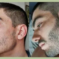 رویش ریش و مو ازهمین امروز