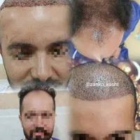 کلینیک کاشت مو لیسار با تخفیف های ویژه