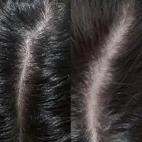 اسکراب اسکالپ تخصصی|خدمات آرایشگری و زیبایی|محمودآباد, |دیوار