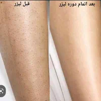 20%تخفیف خدمات پوستی،co2فرکشنال،ریموو تتو،کیوسویج|خدمات آرایشگری و زیبایی|سیرجان, |دیوار