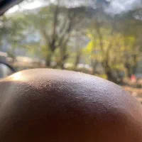 بیماران الوپسی