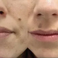 پاک کردن تتوهای صورت وبدن|خدمات آرایشگری و زیبایی|کرمان, |دیوار