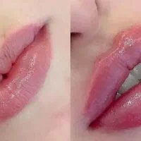 نیازمند مدل برای تزریق ژل