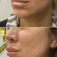 جشنواره اندولیفت تخصصی صورت وگردن|خدمات آرایشگری و زیبایی|تهران, جماران (نیاوران)|دیوار