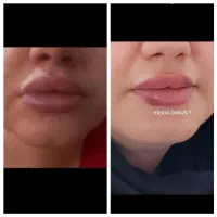 تزریق تخصصی فیلر،بوتاکس،مزو وآنزیم درمطب|خدمات آرایشگری و زیبایی|کرمانشاه, |دیوار