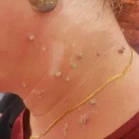 برداشتن خال زگیل و میخچه با محلول صدر صد گیاهی|آرایشی، بهداشتی، درمانی|کرمان, |دیوار