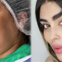 ساکشن غبغب بلفارو کاشت ابرو بوکال فت اموزش ساکشن