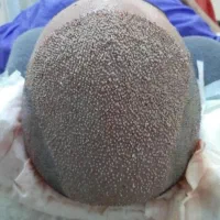 کاشت مو طبیعی له روش میکروfit وsut|خدمات آرایشگری و زیبایی|رامشیر, |دیوار