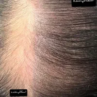 میکرو اسکالپ سر|خدمات آرایشگری و زیبایی|شیراز, اصلاح‌نژاد|دیوار