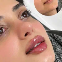 تخفیف ژل و بوتاکس با آفر ۵۰٪ ازدست ندید