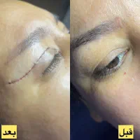 جشنواره تزریق چربی جراحی پلک ساکشن غبغب