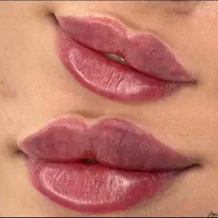 ژل لب چونه گونه زاویه بوتاکس prp لیزر مو بدن هایفو