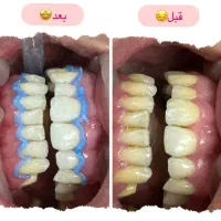 پاکسازی حرفه ای دندان