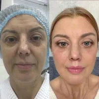 بوتاکس ژل نخ بلفاروپلاستی مزو چربی|خدمات آرایشگری و زیبایی|اصفهان, مولوی|دیوار