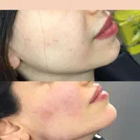 تزریق ژل و بوتاکس