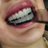 دندانپزشکی باتعرفه دولتی عصب‌کشی کامپوزیت|خدمات آرایشگری و زیبایی|تهران, تهرانپارس غربی|دیوار