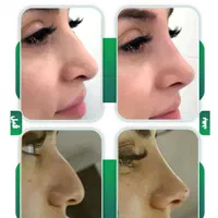 لیفت تخصصی صورت بانخ ،فرمدهی بینی ،لیفت ابرو شقیقه|خدمات آرایشگری و زیبایی|مشهد, احمدآباد|دیوار