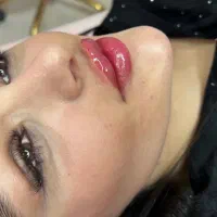 فیلر فول فیس ژل بوتاکس prp مزوتراپی