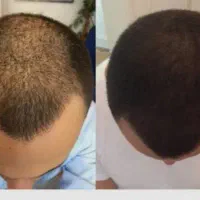 تتو اسکالپ کف سر