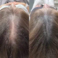 خواهان مدل برای prp مو و صورت