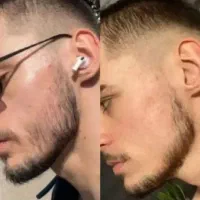 تضمینی رویش مو