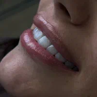 کامپوزیت دندان با ۵۰درصد تخفیف