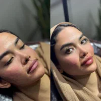 ژل و فیلر صورت و بدن|خدمات آرایشگری و زیبایی|اصفهان, ملک|دیوار