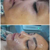 لیزرموهای زائدالکساندرایت،تنگ کردن وروشن کردن واژن|خدمات آرایشگری و زیبایی|کرج, کارخانه قند|دیوار