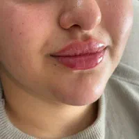 تزریق ژل ، بوتاکس و مزوژل